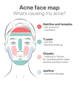 acne face map sk:n clinics breakout