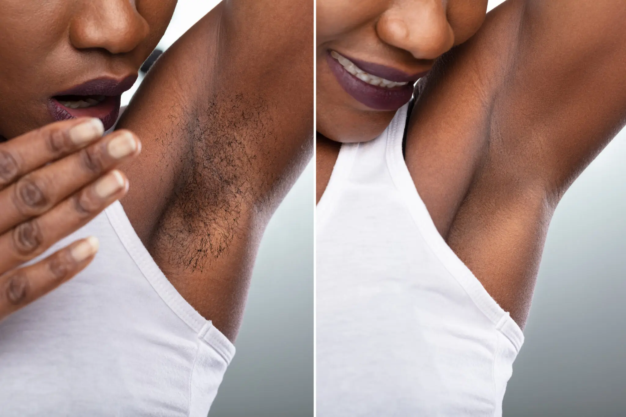 Laser Hair Removal for Dark Skin: Everything you Need to Know